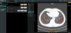 Coreline Soft to Showcase Innovation in AI-Driven Chest Diagnostics with ‘AVIEW LCS Plus’ at ATS 2025 in San Francisco