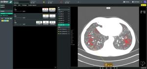 Coreline Soft Leads Public Healthcare AI Growth with Boramae Hospital Partnership